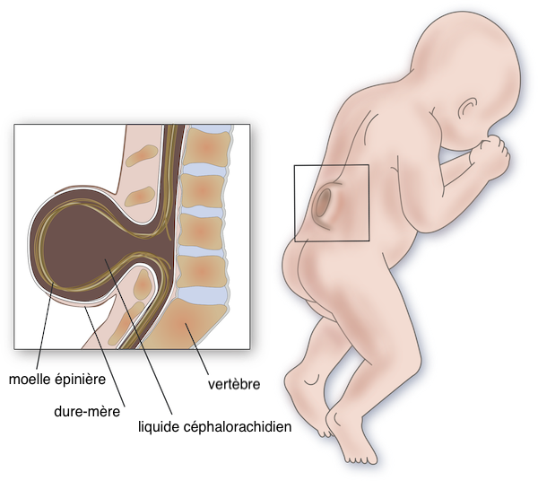 Spina bifida<br>(dos ouvert)