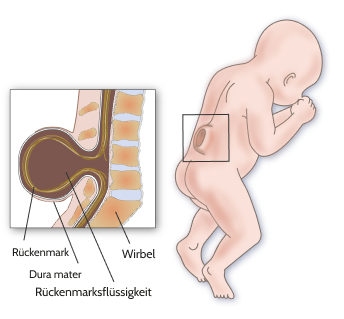 Spina bifida<br>(Offener Rücken)
